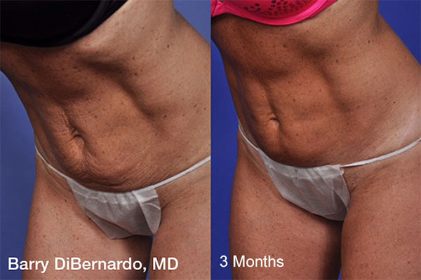 THERMItight® is a minimally invasive/non-surgical treatment that will target the fatty tissue in certain areas of your body, beginning with the first treatment.