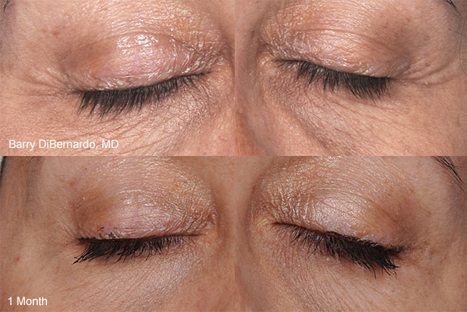 THERMIsmooth Face is a non-invasive dermal remodeling treatment used to target fine wrinkles and tighten the skin on the face.