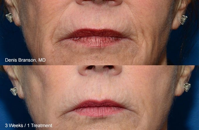 THERMIsmooth Face is a non-invasive dermal remodeling treatment used to target fine wrinkles and tighten the skin on the face.